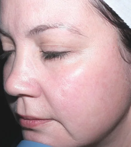 Halo Laser Treatment Before After 2