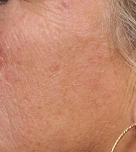 Halo Laser Treatment Before After 3