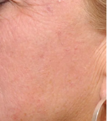 Halo Laser Treatment Before After 4