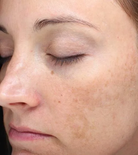 Halo Laser Treatment Before After 5