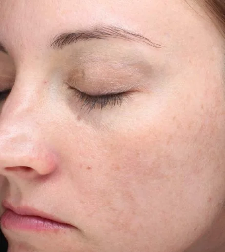 Halo Laser Treatment Before After 6