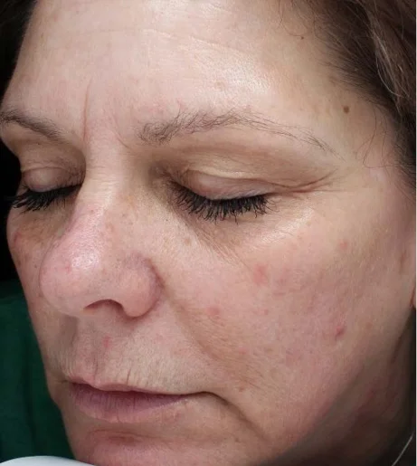 Halo Laser Treatment Before After 7