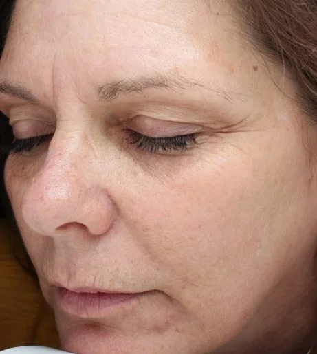 Halo Laser Treatment Before After 8