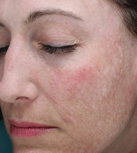Halo Laser Treatment Before After 9