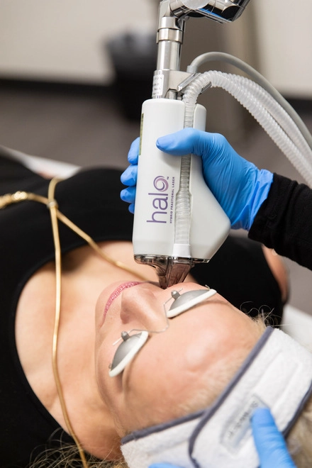 Signature Cosmetic Clinic Laser Halo