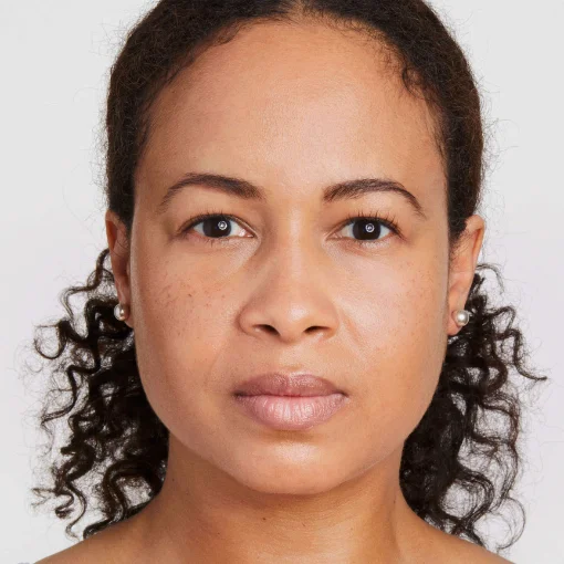 Ultherapy PRIME before after 1