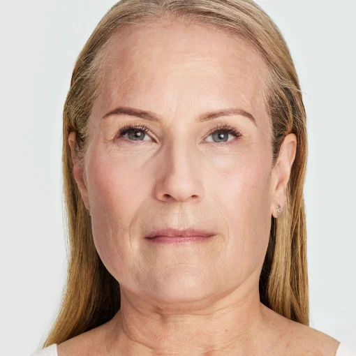 Ultherapy PRIME before after 3
