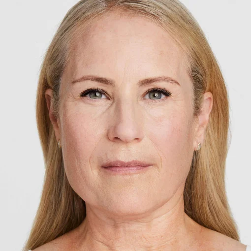 Ultherapy PRIME before after 4