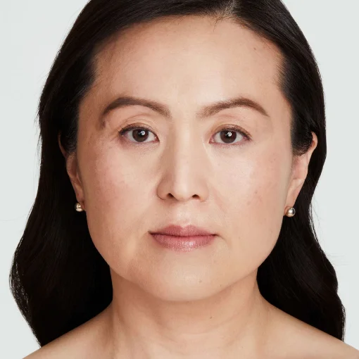 Ultherapy PRIME before after 5
