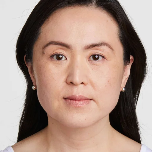 Ultherapy PRIME before after 6