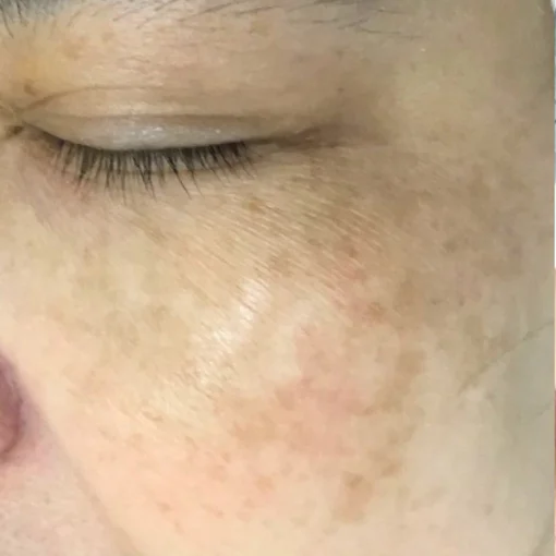 signature cosmetic clinic double pico before after 1