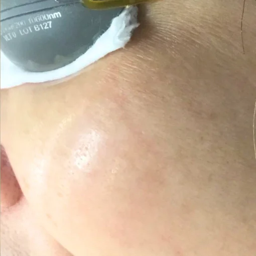 signature cosmetic clinic double pico before after 2