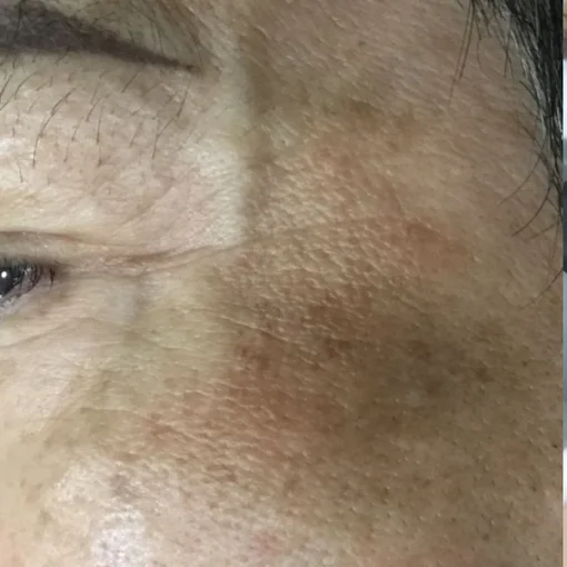 signature cosmetic clinic double pico before after 3