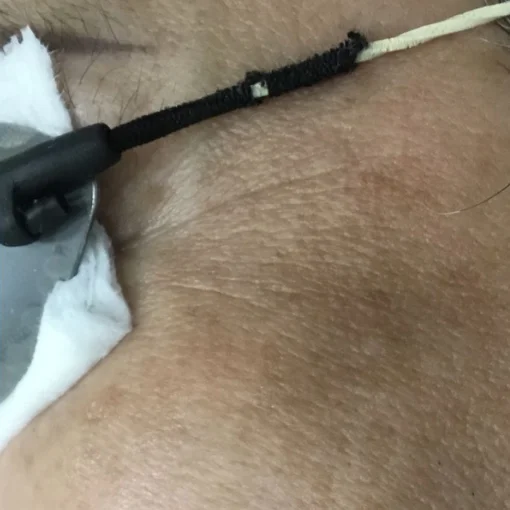 signature cosmetic clinic double pico before after 4