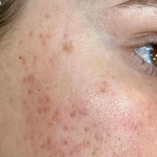 Potenza RF Microneedling Before After 1