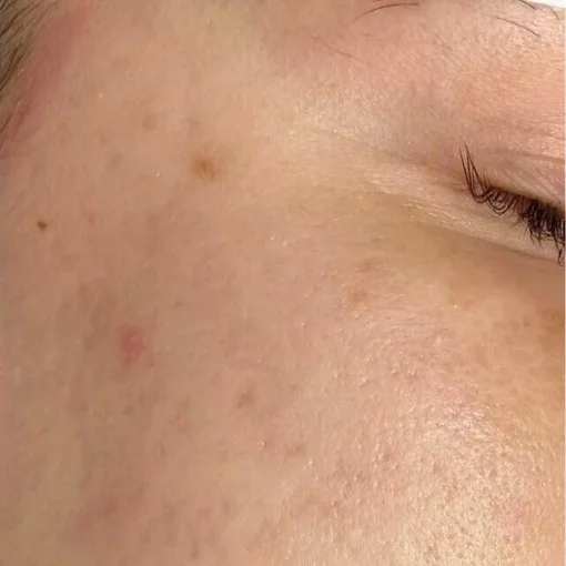 Potenza RF Microneedling Before After 2