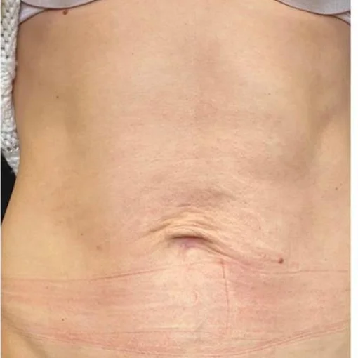 Potenza RF Microneedling Before After 3