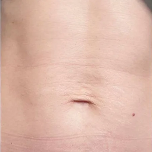 Potenza RF Microneedling Before After 4