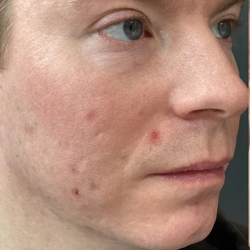 Potenza RF Microneedling Before After 5