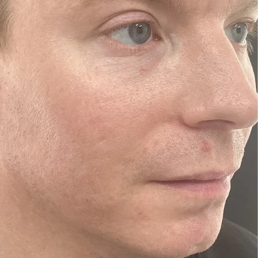 Potenza RF Microneedling Before After 6