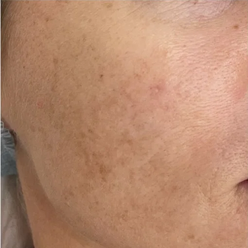 Sun Damage Before After 1