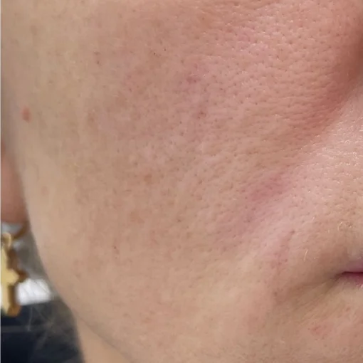 Sun Damage Before After 2