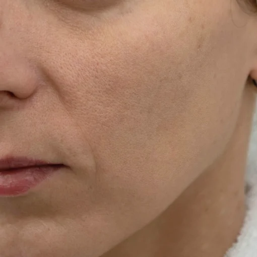 Sun Damage Before After 3