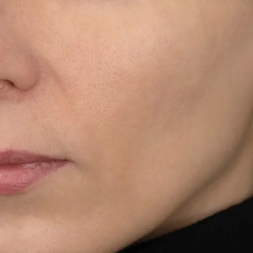 Sun Damage Before After 4