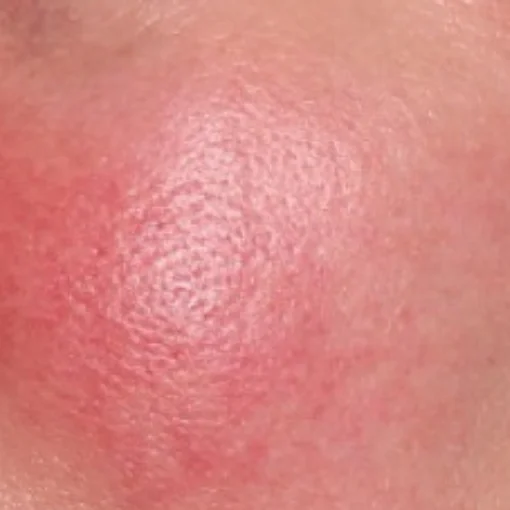 Sun Damage Before After 5