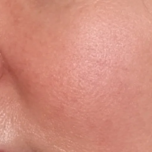 Sun Damage Before After 6