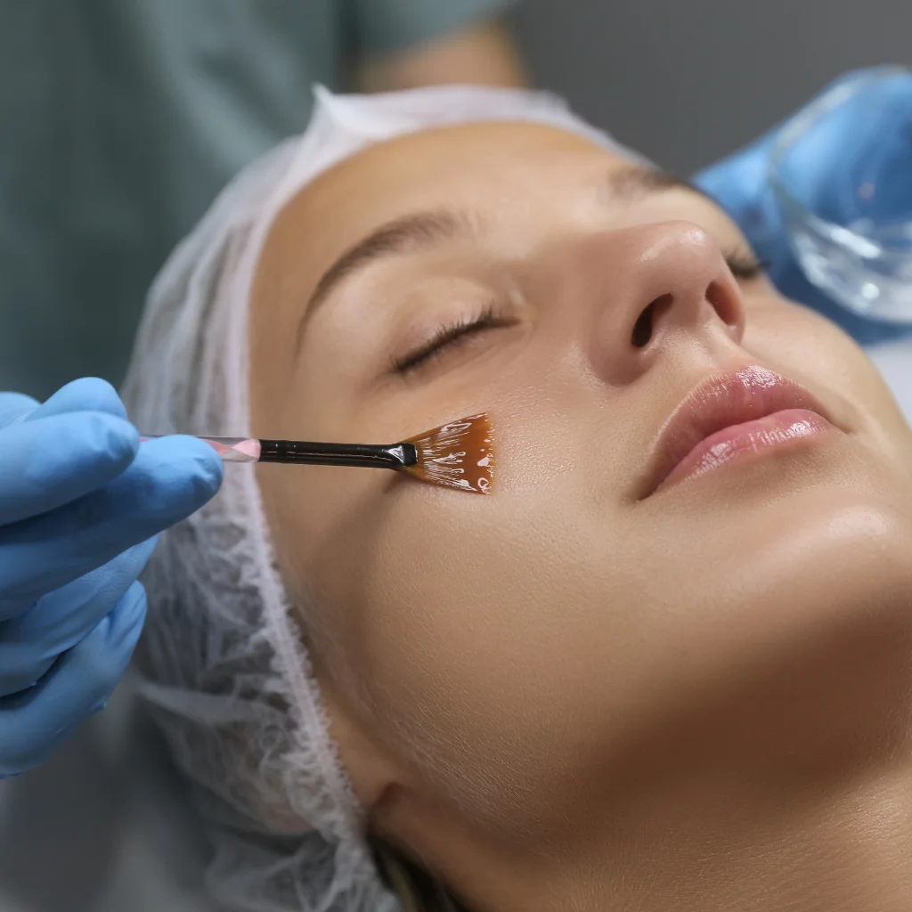 Sun Damage - Chemical Peel