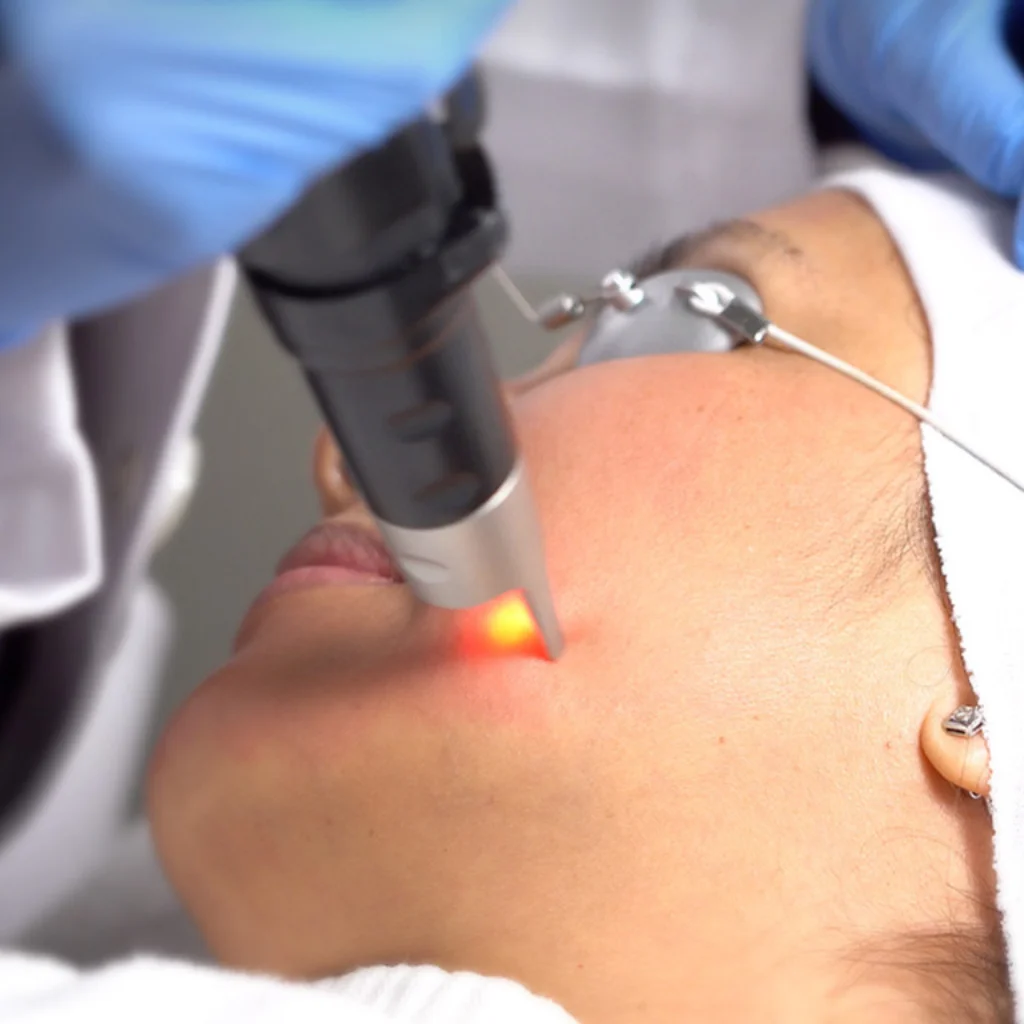 Sun Damage - Laser Therapy